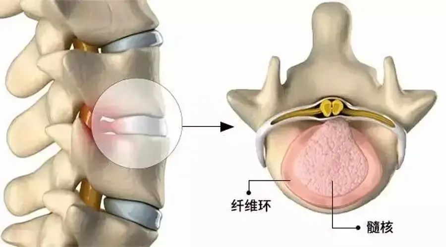椎間盤突出