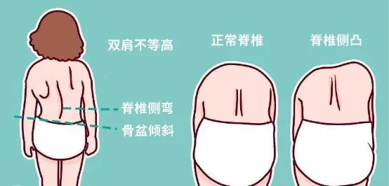 脊柱側彎