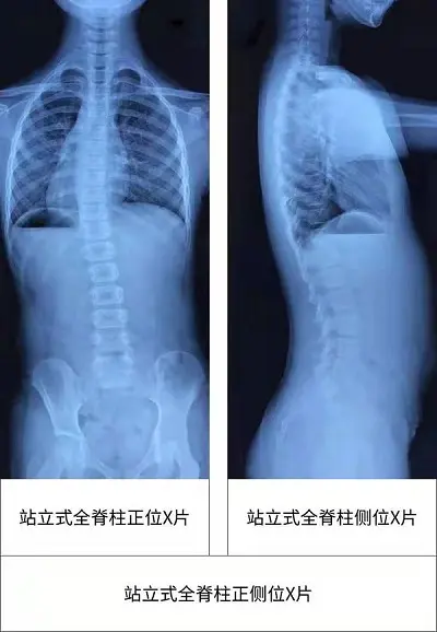 全脊柱正側(cè)位x光片
