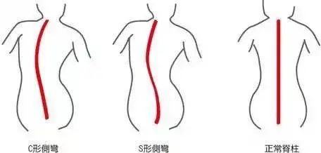 脊柱側(cè)彎