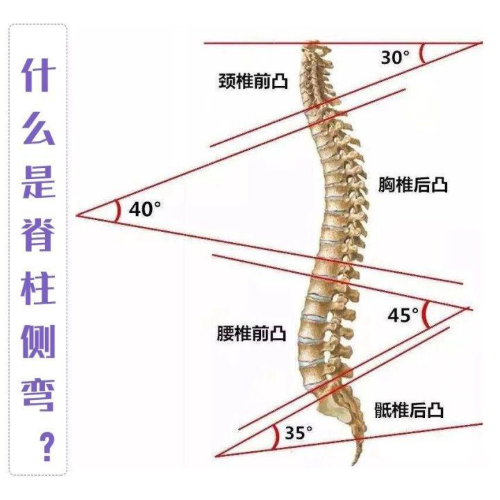 脊柱側彎